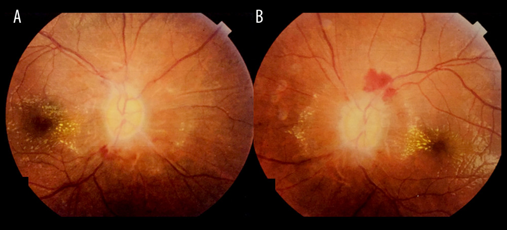 Posterior segment examination of the A: right and B: left eyes revealed bilateral grade IV papilledema with optic disc pallor and flame-shaped retinal hemorrhages along the disc margins, with hard exudates extending into the macular area.