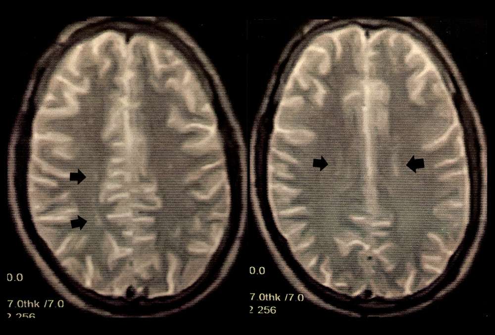 Magnetic resonance imaging of the brain revealed a few bilateral periventricular, oval-shaped foci of abnormal signal intensity scattered in the deep white matter, with bright signals on T2-weighted images (black arrows).