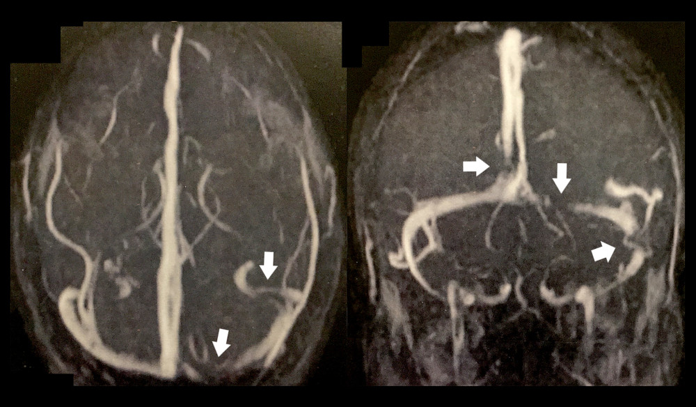 Magnetic resonance venography revealed multiple filling defects involving the proximal aspect of the superior sagittal sinus and the medial and lateral aspects of the left transverse sinus (white arrows).