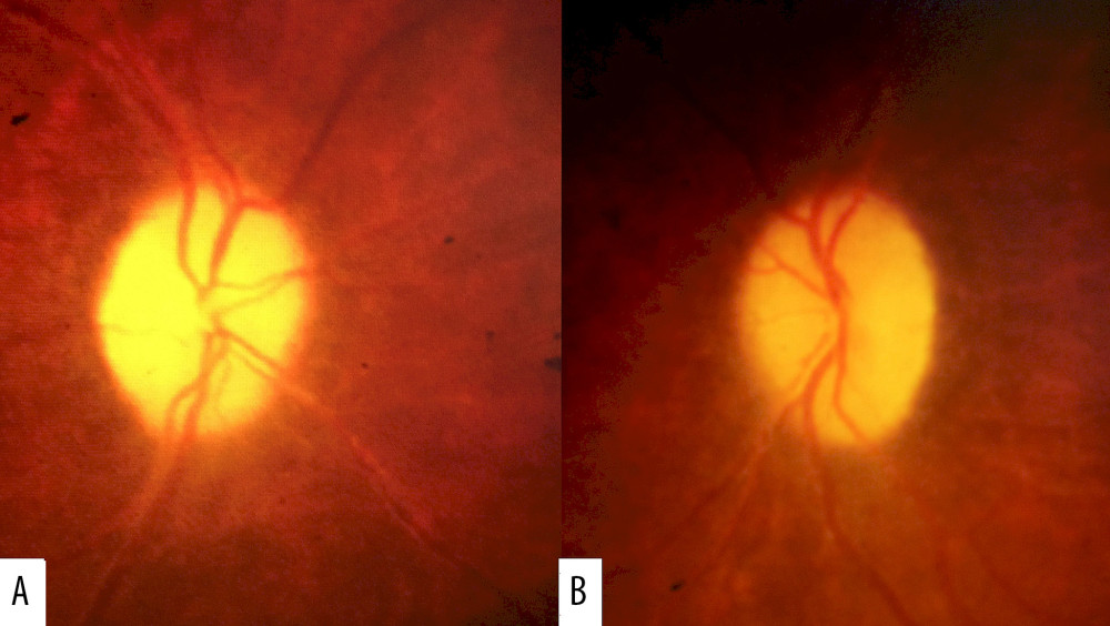 One month after right optic nerve sheath fenestration, posterior segment examination revealed resolution of papilledema in the A: right and B: left eyes with persistent optic disc pallor.