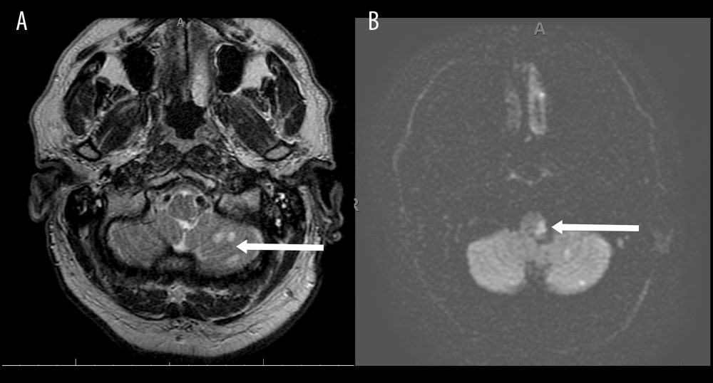 T2-weighted (A) and diffusion (B) magnetic resonance imaging demonstrating multiple foci of acute infarction in the left cerebellar hemisphere in the left posterior inferior cerebellar artery distribution (white arrow in A) and the left side of the medulla (white arrow in B). Cerebellar infarcts are also visible in Figure B (no arrows).
