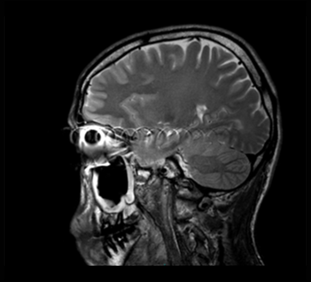 Brain and orbit magnetic resonance imaging showed a typical susceptibility artifact that obscured the anatomical structures of the left orbit and surrounding regions. Such artifacts are typically associated with ferromagnetic substances.