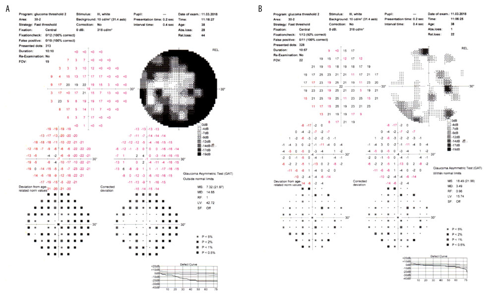 Visual field testing showed double arcuate scotoma (A) denser nasally in the left eye and (B) normal in the right eye.