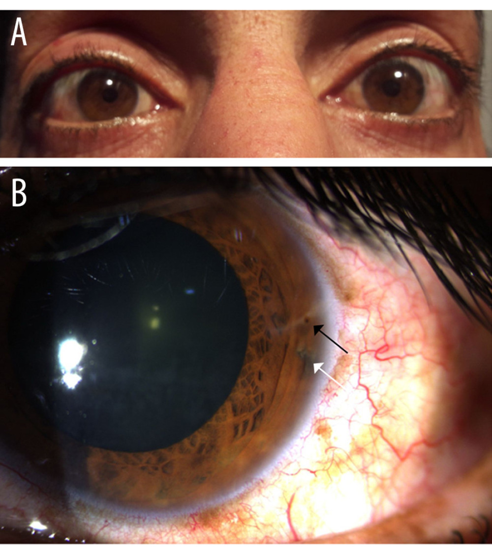 (A) The left pupil looks slightly dilated. (B) The left eye showed a temporal horizontal corneal scar at 3 o’clock near the limbus, with corresponding iridotomy posterior to the wound