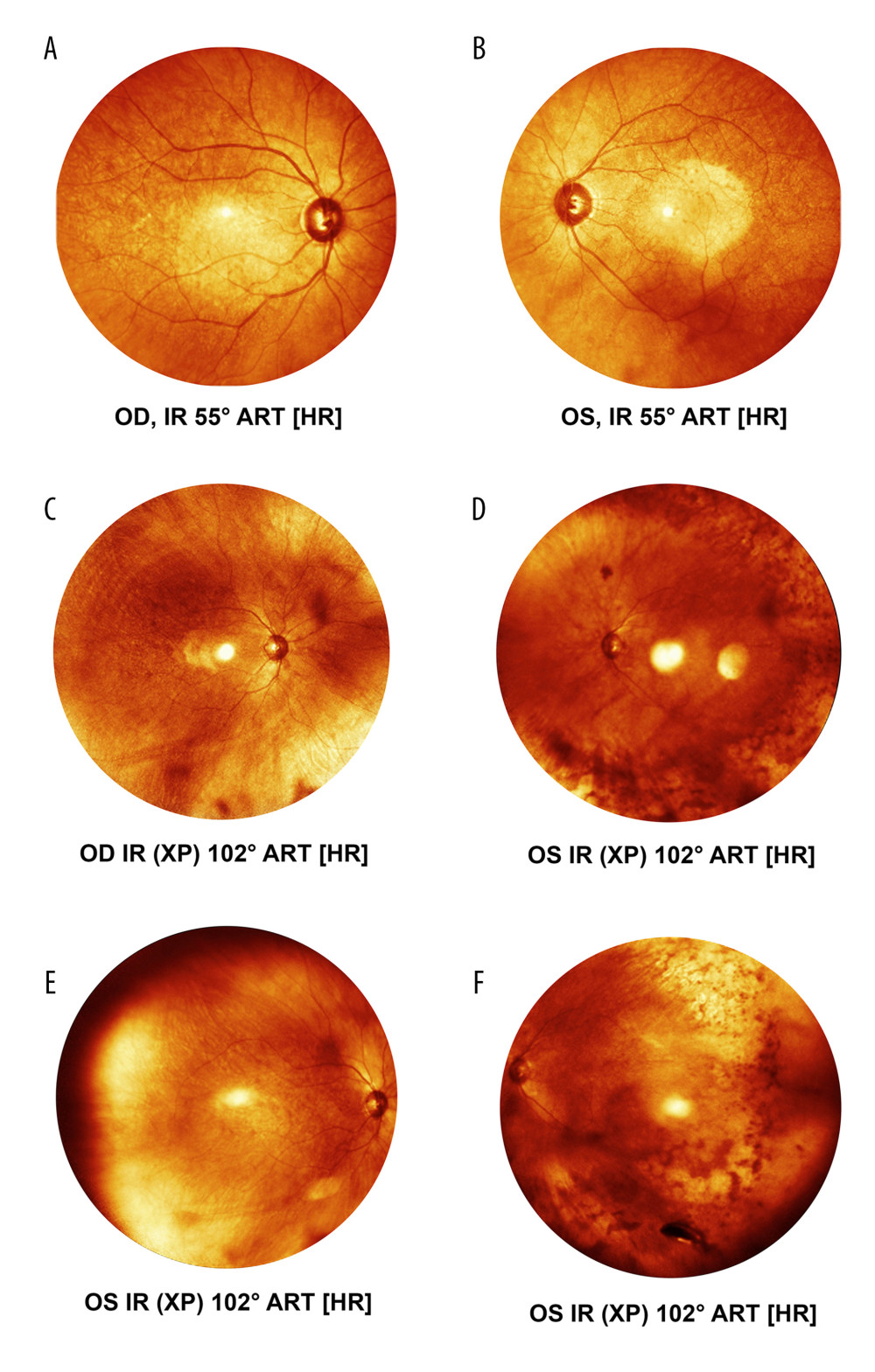 (A, B) Multicolor fundus photograph using Heidelberg OCT spectralis 55 degree lens. Both eyes looks normal. (C, D) Multicolor fundus photograph using wide-angle Heidelberg OCT spectralis (102 degree). The right eye is normal, while the left eye showed peripheral pigmentary changes. (E, F) Multicolor fundus photograph using wide-angle Heidelberg OCT spectralis (102 degree). The right eye is normal, while the left eye showed peripheral pigmentary changes and small intraocular foreign body (IOFB) in the far anterior periphery inferotemporal.