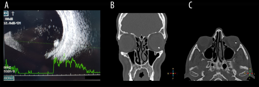 (A) B-scan of the left eye showed the hyperechoic shadow of the intraocular foreign bodies (IOFB). (B, C) Computed tomography scan revealed the IOFB.