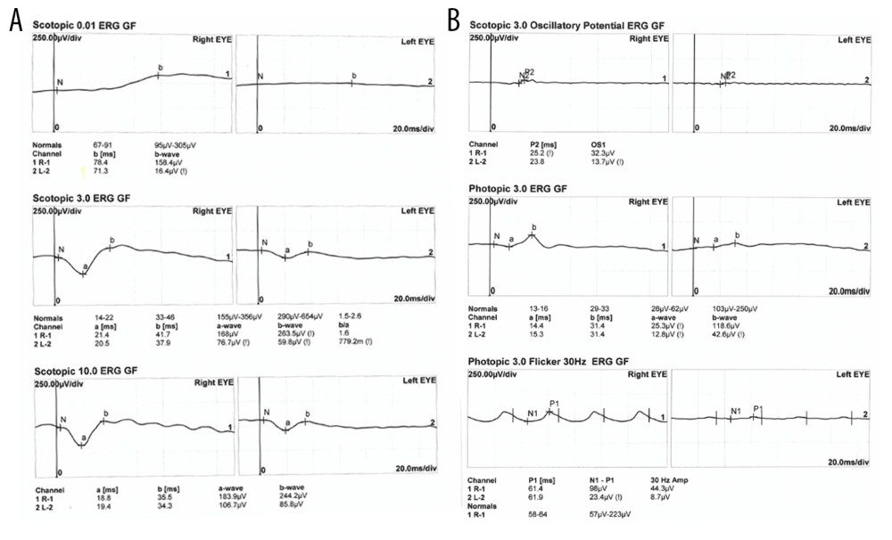 (A, B) Electroretinogram results showed that the 5 responses of the standard electroretinogram were normal in the right eye and abnormal in the left eye. The amplitudes of the scotopic rods and combined rods: cone responses were normal in the right eye but reduced in the left eye; wavelets of oscillatory potentials were normal in the right eye but hardly detectable and reduced in the left eye; and photopic cone responses and flicker responses were normal in the right eye but reduced in the left eye.