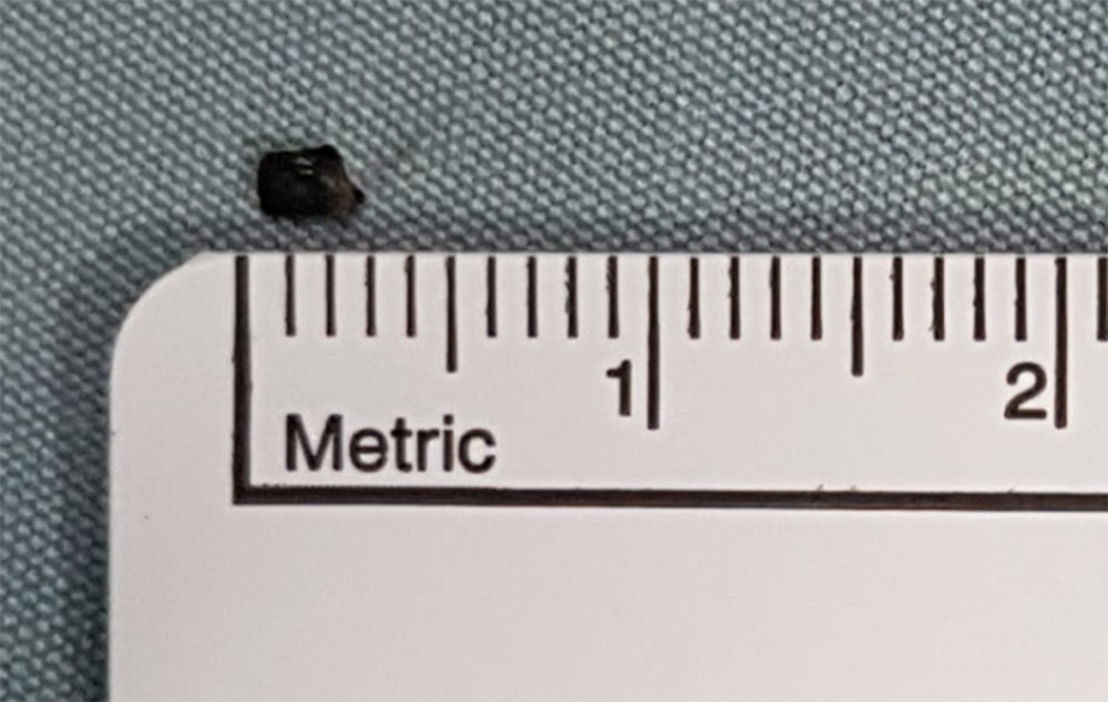 The intraocular foreign body after surgical removal. Dimensions were 3.00×2.00×1.00 mm.