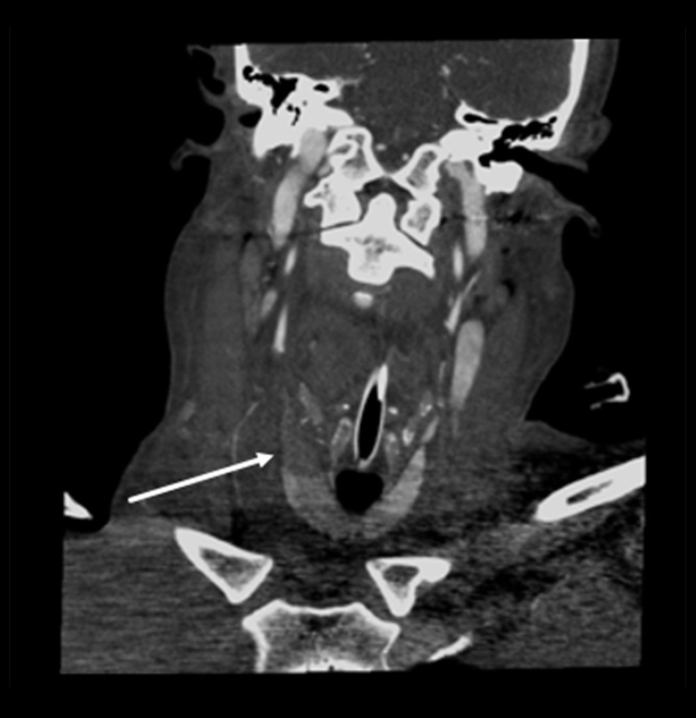 A coronal neck computed tomography angiogram shows enlargement/edema of the right thyroid lobe with asymmetric decreased parenchymal enhancement of the mid and superior aspects of the right thyroid lobe (arrow). Note the preserved parenchymal enhancement of the lower pole of the right thyroid lobe. An endotracheal tube is partially visible.