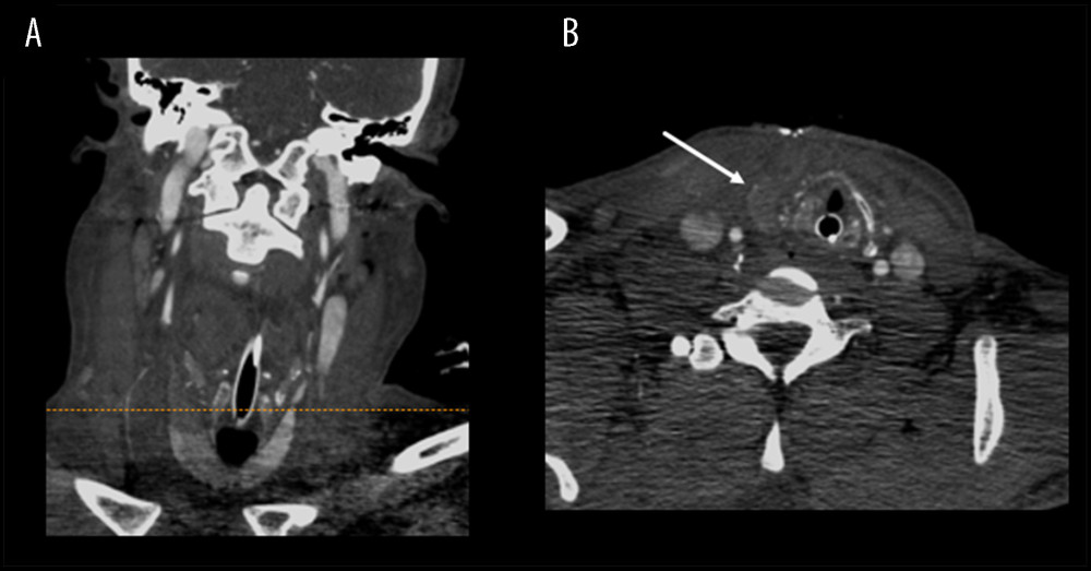 (A) A coronal computed tomography angiogram of the neck. (B) An axial slice through the upper pole of the right thyroid lobe shows edema and decreased parenchymal attenuation. Note the adjacent comminuted, distracted fracture of the right thyroid cartilage.