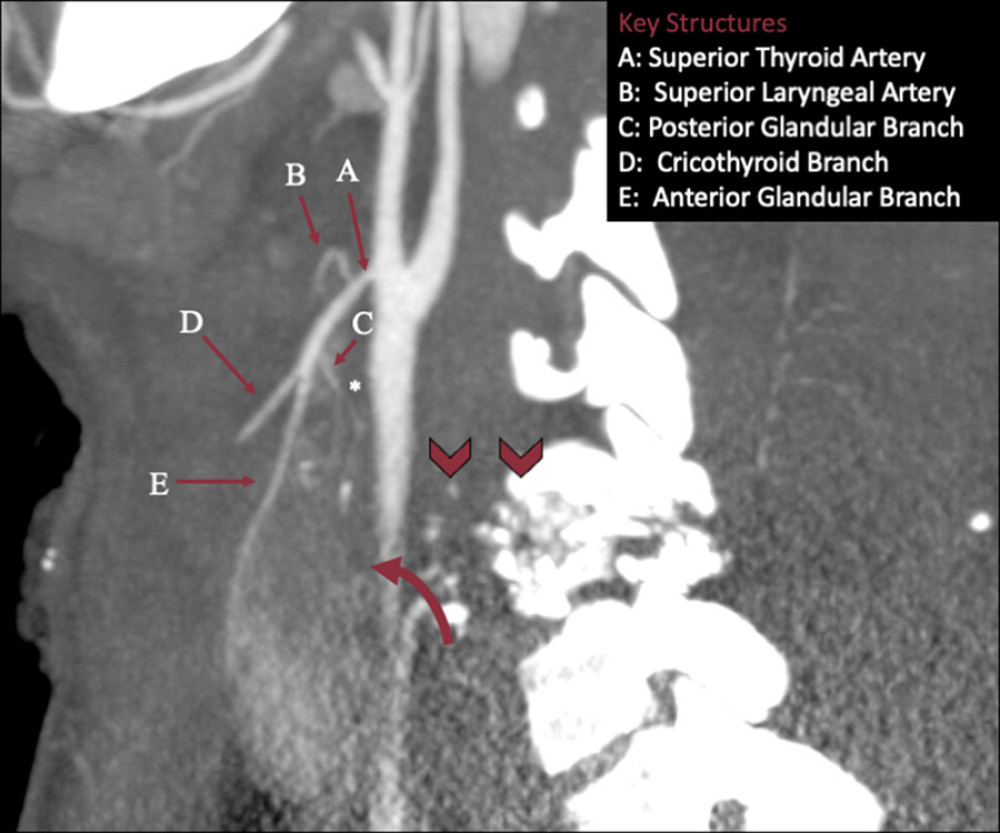 A sagittal computed tomography image of the thyroid vascular supply. Close to the origin of the posterior glandular branch ‘C’ of the right superior thyroid artery ‘A’ there is a suggestion of an abrupt decrease in caliber (*) without distal opacification beyond this point. Note that this finding is at the level of the bullet path (arrowhead) and upper to middle aspect of the right thyroid lobe (curved arrow), which shows decreased parenchymal enhancement. For comparison, the anterior glandular branch ‘D’ has adequate opacification throughout its course. The findings favor vasospasm rather than an arterial injury (arterial transection in the setting of gunshot wounds).