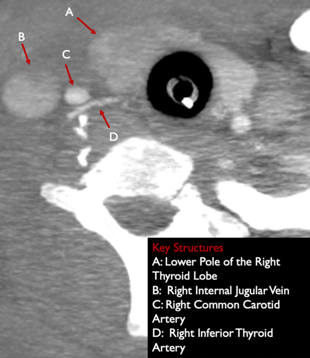 An axial computed tomography angiogram shows adequate opacification of the right inferior thyroid artery ‘D’, which arises from the thyrocervical trunk. ‘A’: Note the normal parenchymal enhancement of the lower pole of the right thyroid lobe.
