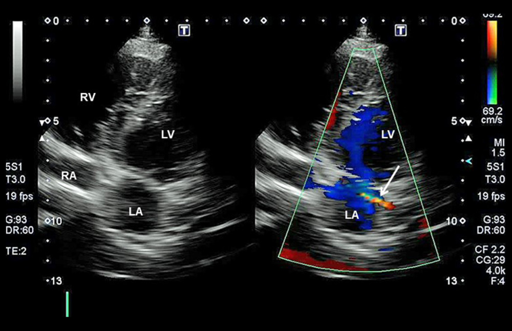 Transthoracic echocardiography images of the modified 4-chamber view showing an abnormal intra-left atrium jet signal (arrow). LA – left atrium; LV – left ventricular; RA – right atrium; RV – right ventricle.