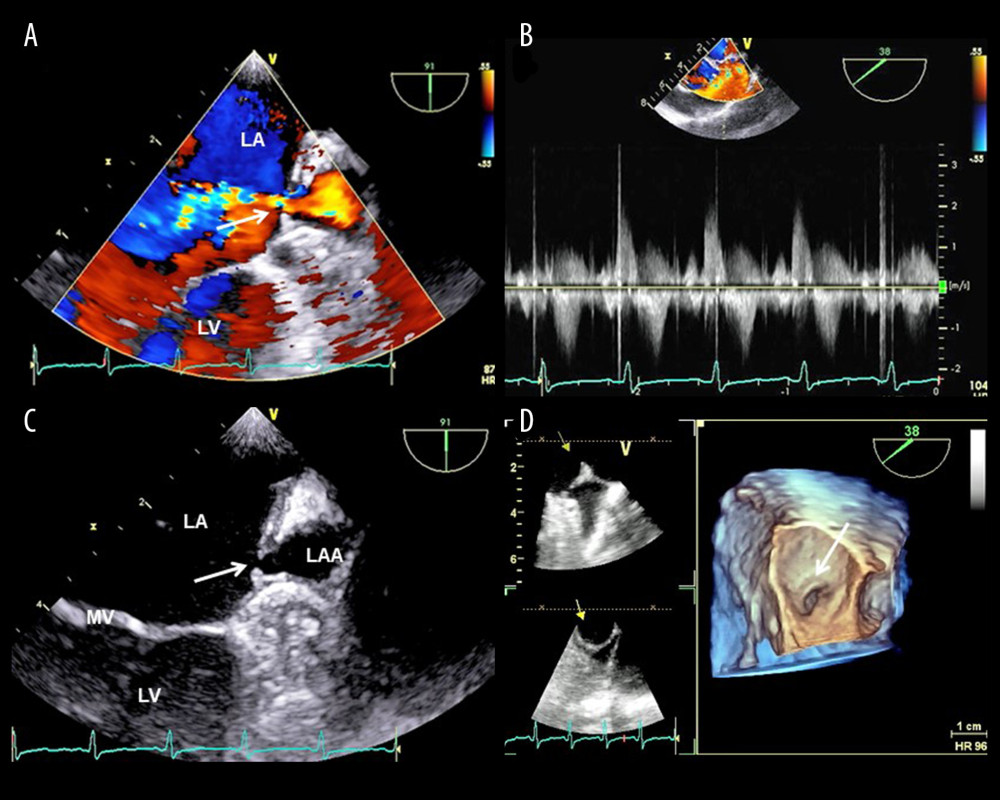Findings from TEE: (A) Color-flow imaging showing a jet signal ejected from within the LAA; (B) Continuous wave Doppler spectrum with a sample volume set around the LAA orifice; (C) 2D image indicative of the LAA orifice narrowing; (D) 3D image of the surgeon’s view demonstrating the narrowed LAA orifice. Abbreviations are the same as in Figure 1.