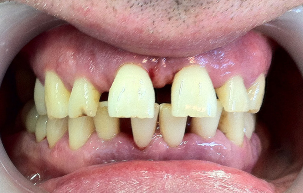 Clinical view revealing the scale of the terminal stage periodontal disease in the front teeth.