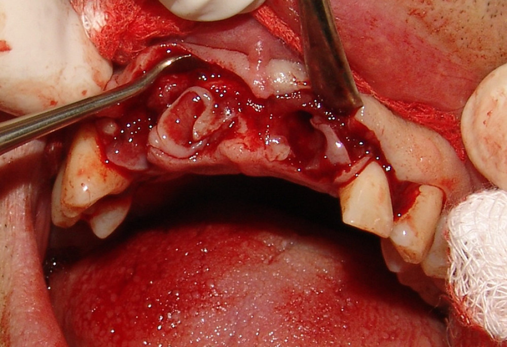 Intraoperative appearance of the site after extraction of the maxillary incisors.