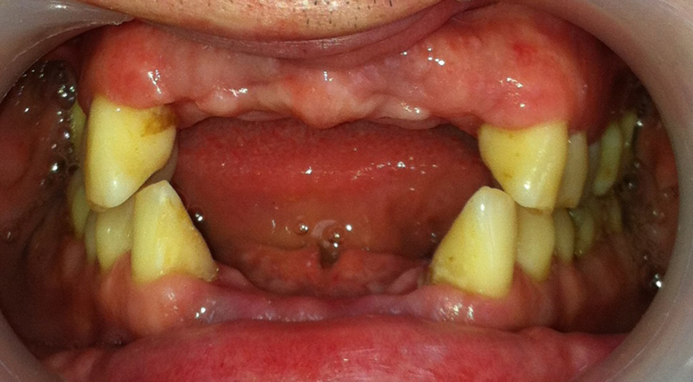 Restitution of the extraction sites after 8 weeks, with noticeable negligence of oral hygiene.