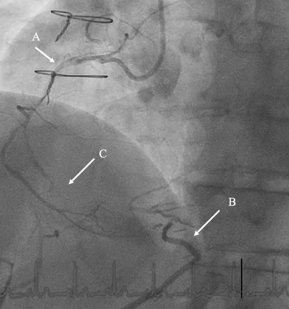 Angiography. A) Dual injection of the right coronary artery (RCA). B) The gastroepiploic graft. C) Chronic total occlusion (CTO) of the RCA is shown.