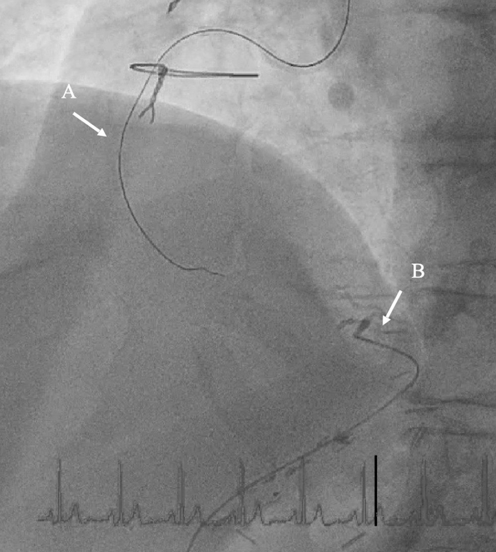 Angiography. A) The advancement of antegrade wire through the right coronary artery (RCA). B) The Corsair microcatheter is shown in the gastroepiploic graft.