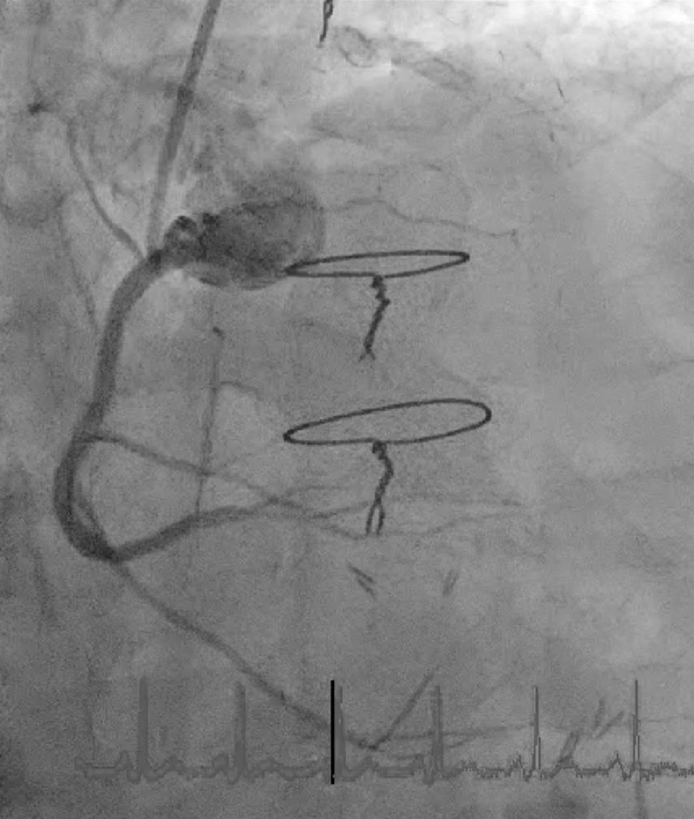 Final angiographic result. The right coronary artery (RCA) is shown following the successful CART procedure.