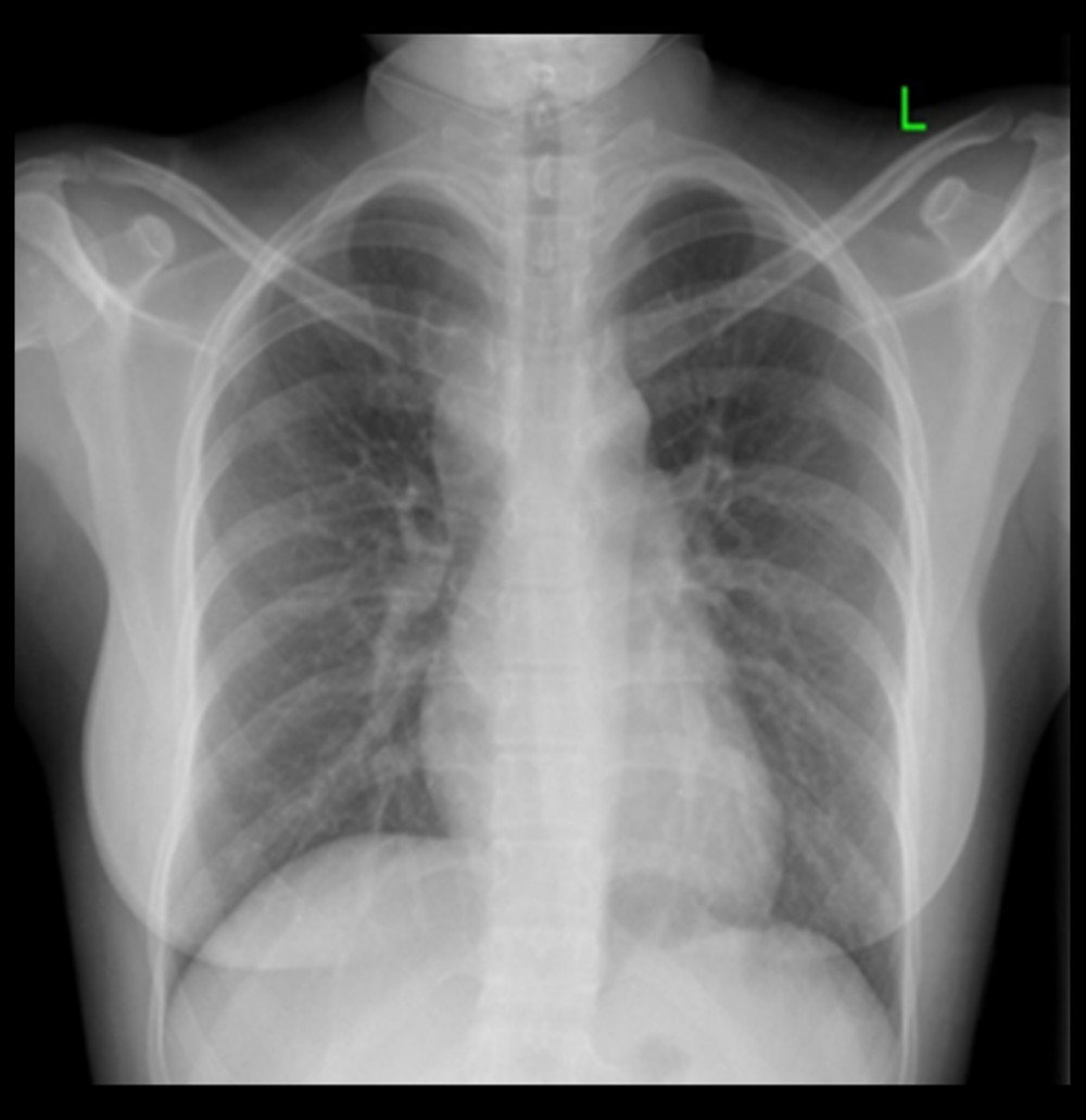 Chest radiograph (posteroanterior view). Chest X-ray posteroanterior view showing normal study.