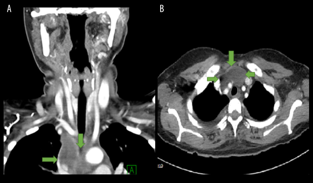 Computed tomography (CT) neck-thorax coronal (A) and axial (B) view. CT neck-thorax coronal (A) and axial (B) view showing septated peripherally enhancing anterior-superior mediastinal collection (green arrows).