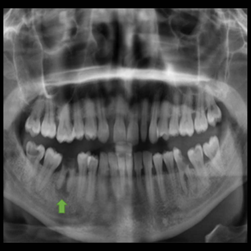 X-ray orthopantomogram. X-ray orthopantomogram showing lucency around the lower premolar root, consistent with the clinical suspicion of abscess formation (green arrow).