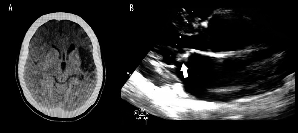 (A) Brain computed tomography showing a left frontoparietal hypodensity. (B) Transthoracic echocardiogram showing a sessile, isoechoic mass adhered to the atrial surface of the anterior leaflet of the mitral valve.