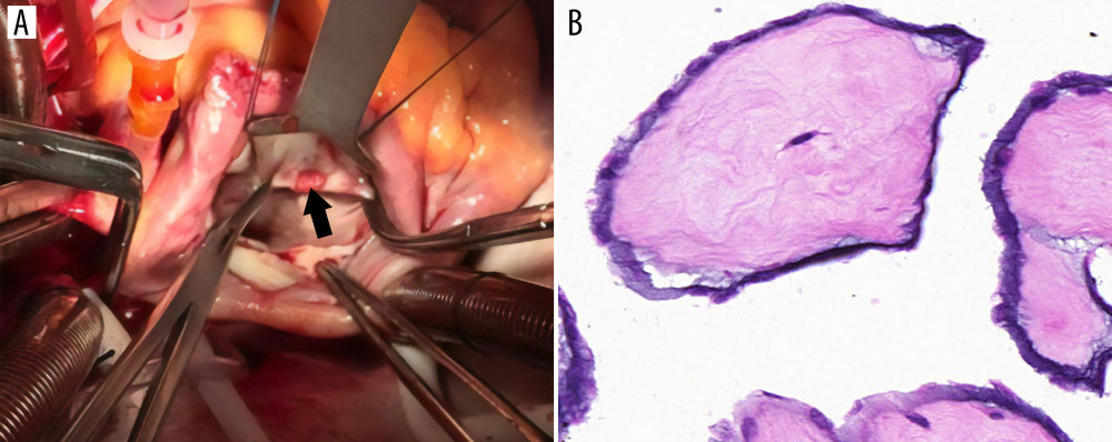 (A) Intraoperative view showing a mass attached to the anterior mitral valve leaflet. (B) Microscopy of the tumor showing elongated and branching papillary fronds composed of central avascular collagen and lined by hyperplastic endothelial cells.