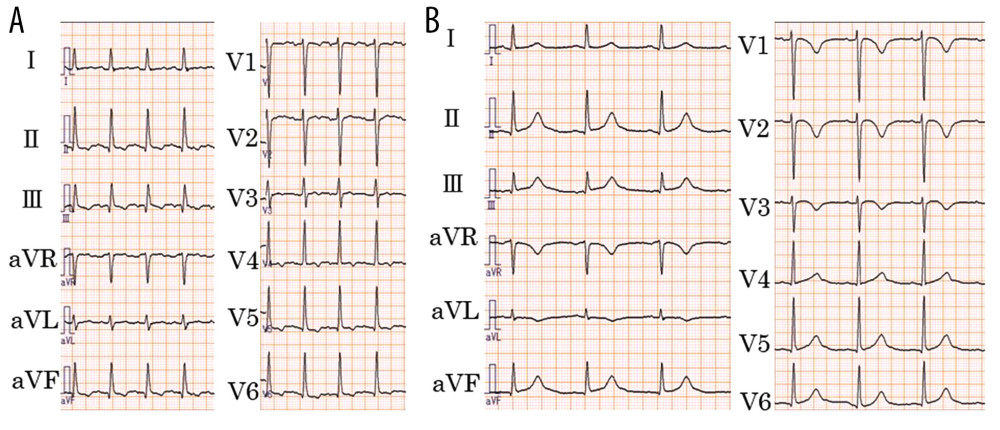 Electrocardiogram on admission (A) and the day before the onset of ventricular fibrillation (B).