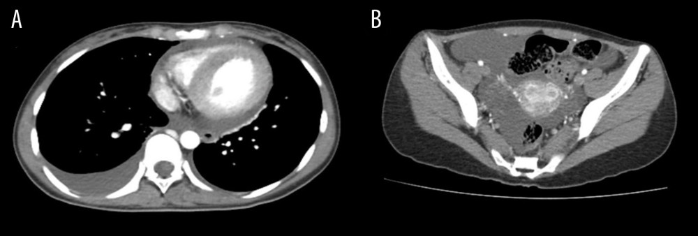 Computed tomography of the abdomen and pelvis at admission. (A) Right pleural effusion, pericardial effusion. (B) Focal pelvic ascites.