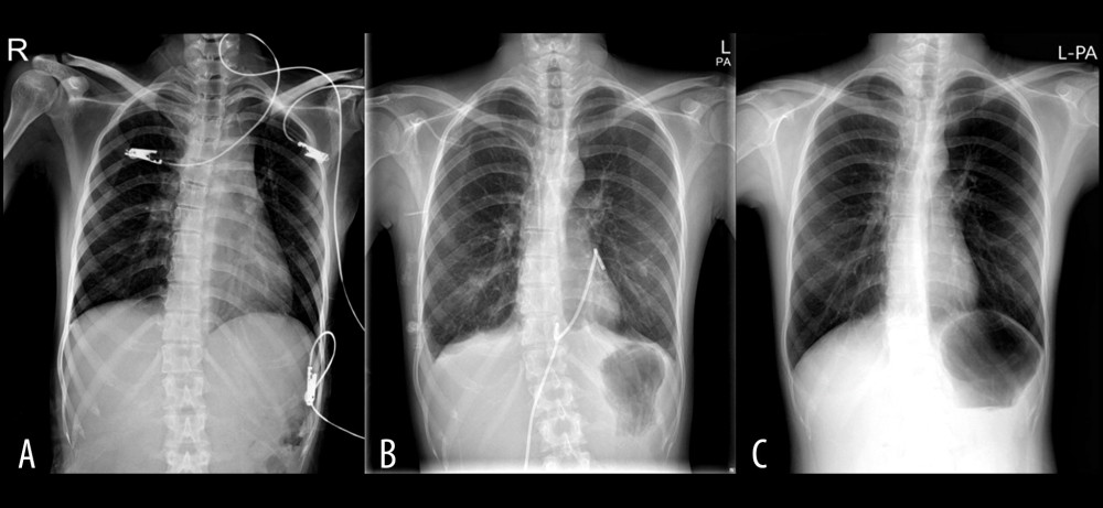Serial changes in the chest X-ray. (A) Initial chest X-ray at admission. (B) X-ray after pericardiocentesis. (C) X-ray before hospital discharge.