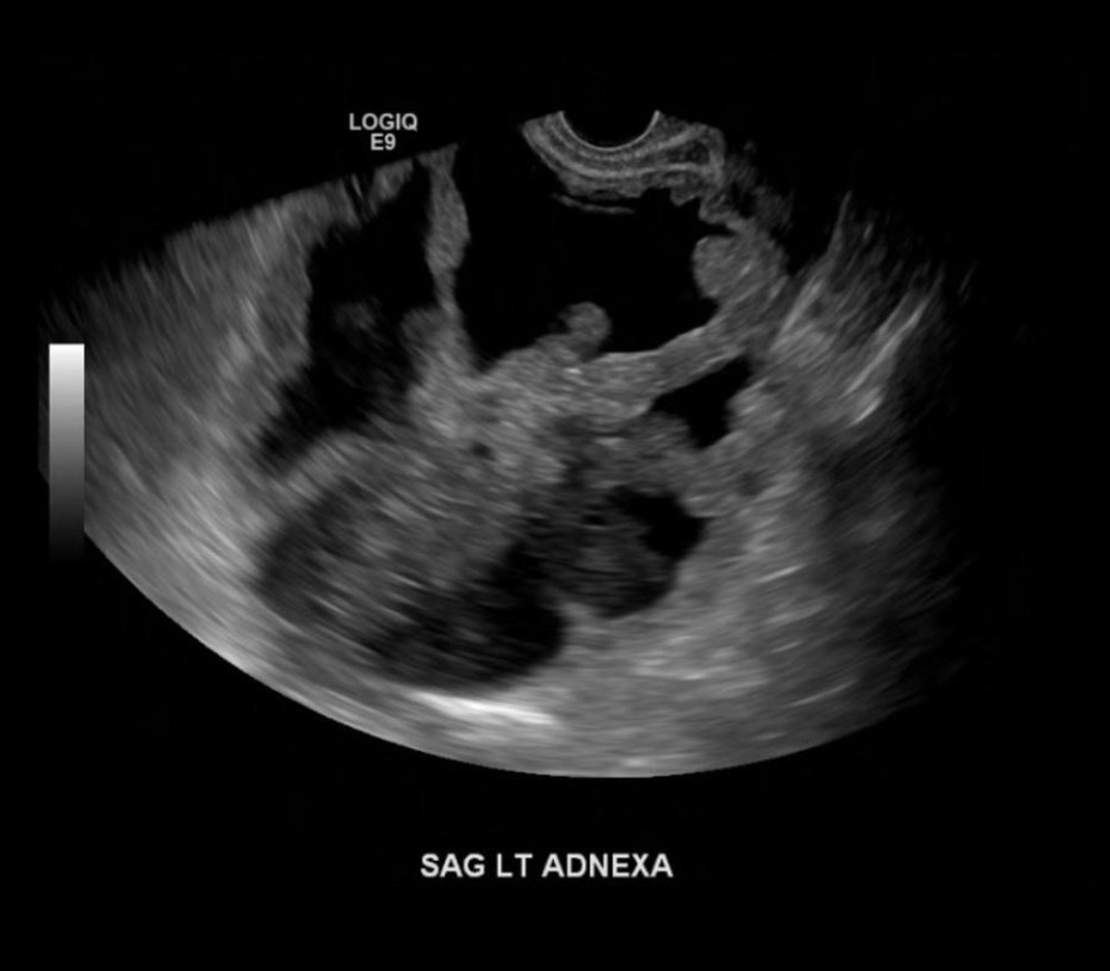 Transvaginal ultrasound was subsequently performed to evaluate the mass. A left adnexal mass, measuring 14.0×13.4×16.7 cm, with thick, nodular septations was visualized.