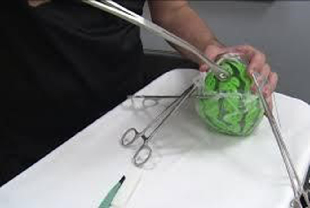 A balloon measuring approximately 17 cm in diameter was used to demonstrate our in-bag morcellation technique. Exteriorization of the bag opening was crucial to minimize the risk of mass rupture intra-abdominally.