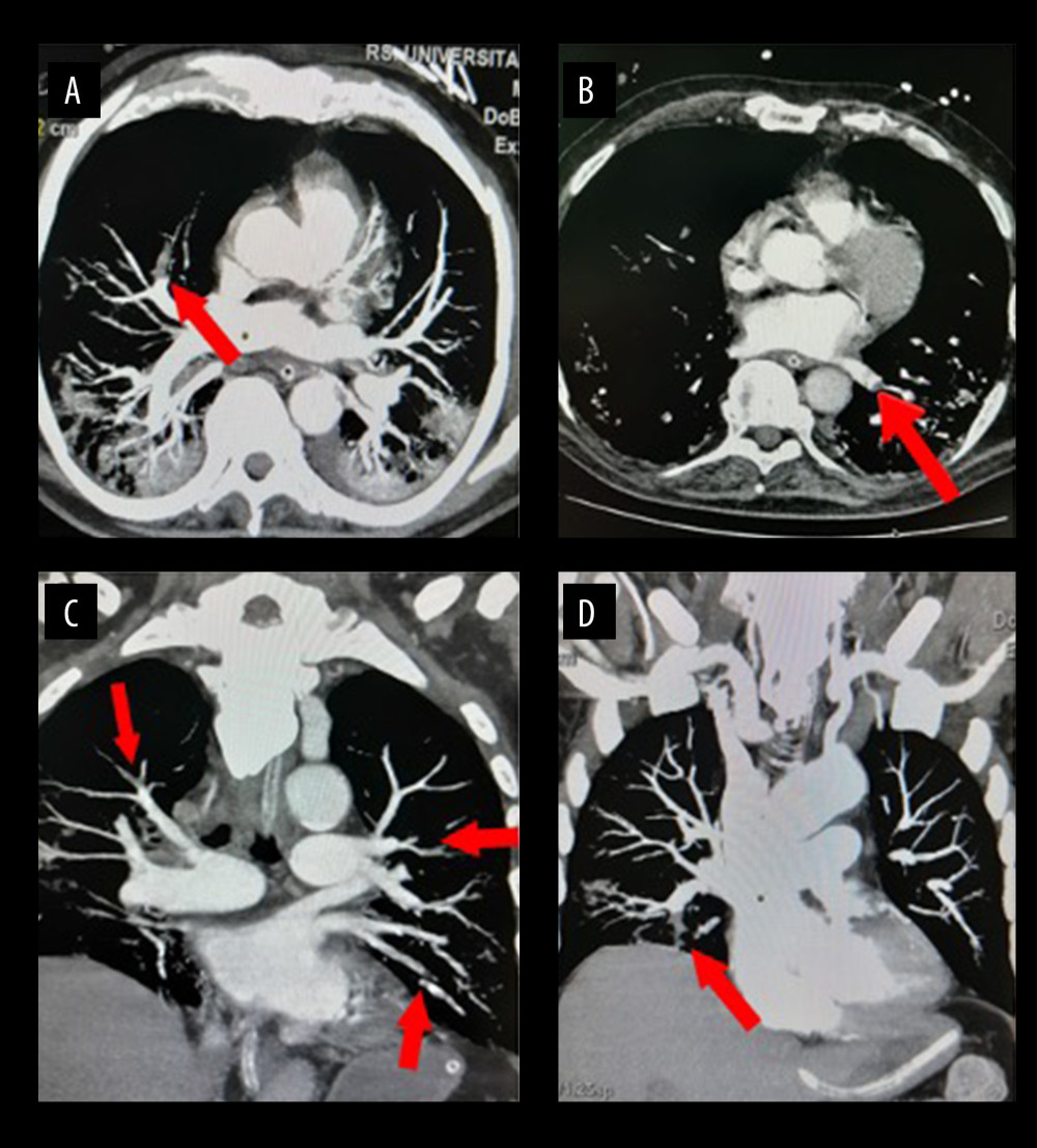CT-pulmonary angiography showing multiple pulmonary thromboses. (A) Filling defect in the apical branch of the superior right pulmonary artery. (B) Filling defect in the left pulmonary vein. (C) Irregularity and filling defect in the lateral basal, lingular, and posterior basal branches of the left pulmonary artery. (D) Filling defect in the anterior basal branch of the right pulmonary artery.