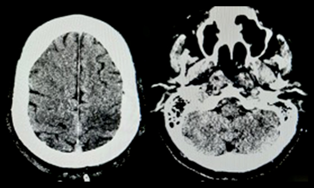 Infarct in the cortical-subcortical left parietal lobe, pons, and left part of the cerebellum.