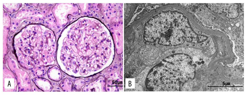 Microscopic features of kidney biopsy. (A) Glomeruli appear unremarkable, and there are no specific vascular or tubulointerstitial lesions (methenamine silver stain, ×400). (B) Foot process effacement is extensive. The glomerular basement membrane is unremarkable, and there are no electron-dense deposits (transmission electron microscope, ×4000).