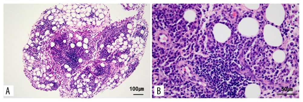 Microscopic features of chronic inflammation in omental tissue. (A, B) Hematoxylin and eosin (H & E) stains show extensive lymphoplasmacytic infiltration in the omental tissue. There are no granulomas or fungal organisms (A: H & E stain, ×100), (B: H & E stain, ×400).