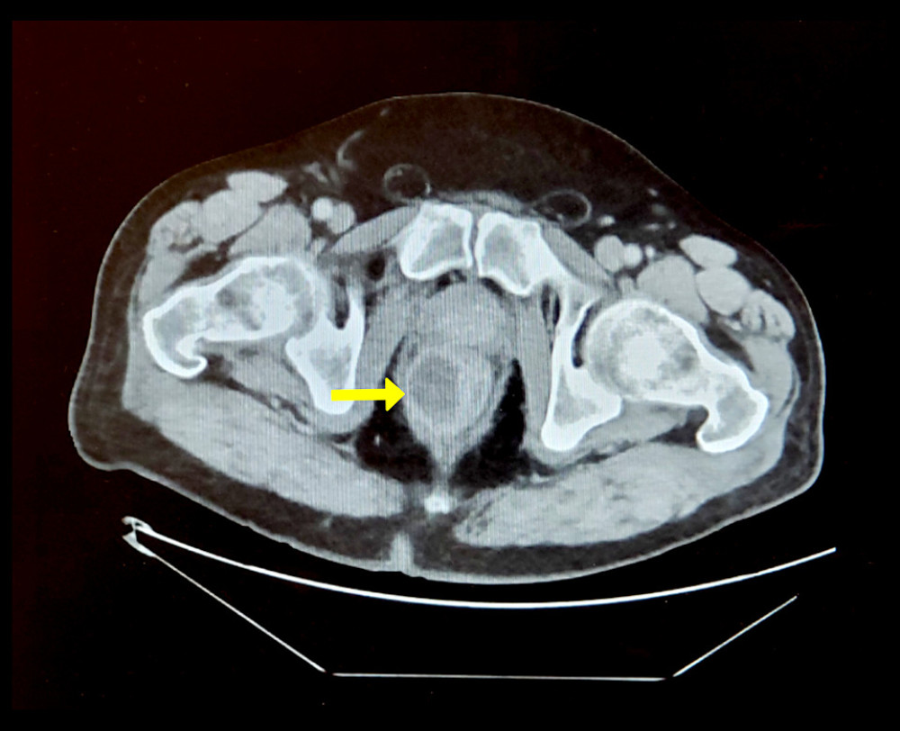 Contrast-enhanced computed tomography scan of the abdomen and pelvis (axial view) reveals a right-sided, rim-enhancing fluid collection near the anorectal junction (yellow arrow).