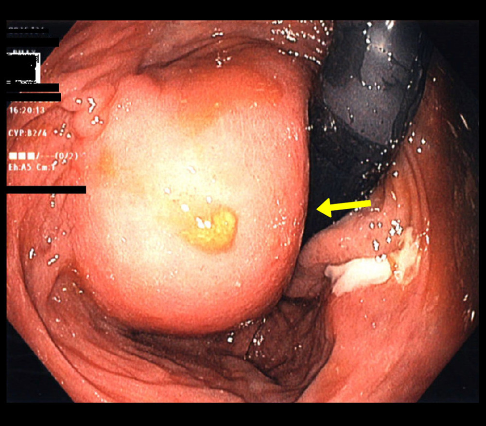 An endoscopic view of the rectum demonstrates a left-sided bulge (yellow arrow) protruding into the lumen, consistent with a perirectal abscess.