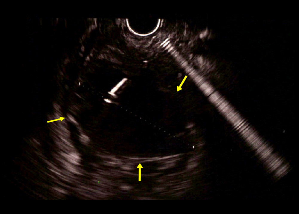 An endoscopic ultrasound shows a hypoechoic cavity with regular walls and homogeneous material, suggestive of an abscess.