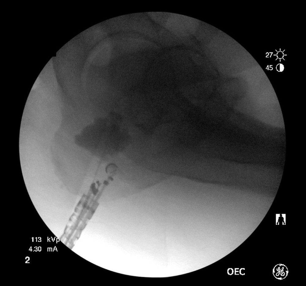 A guidewire is introduced and coiled into the abscess cavity under endoscopic ultrasound guidance.