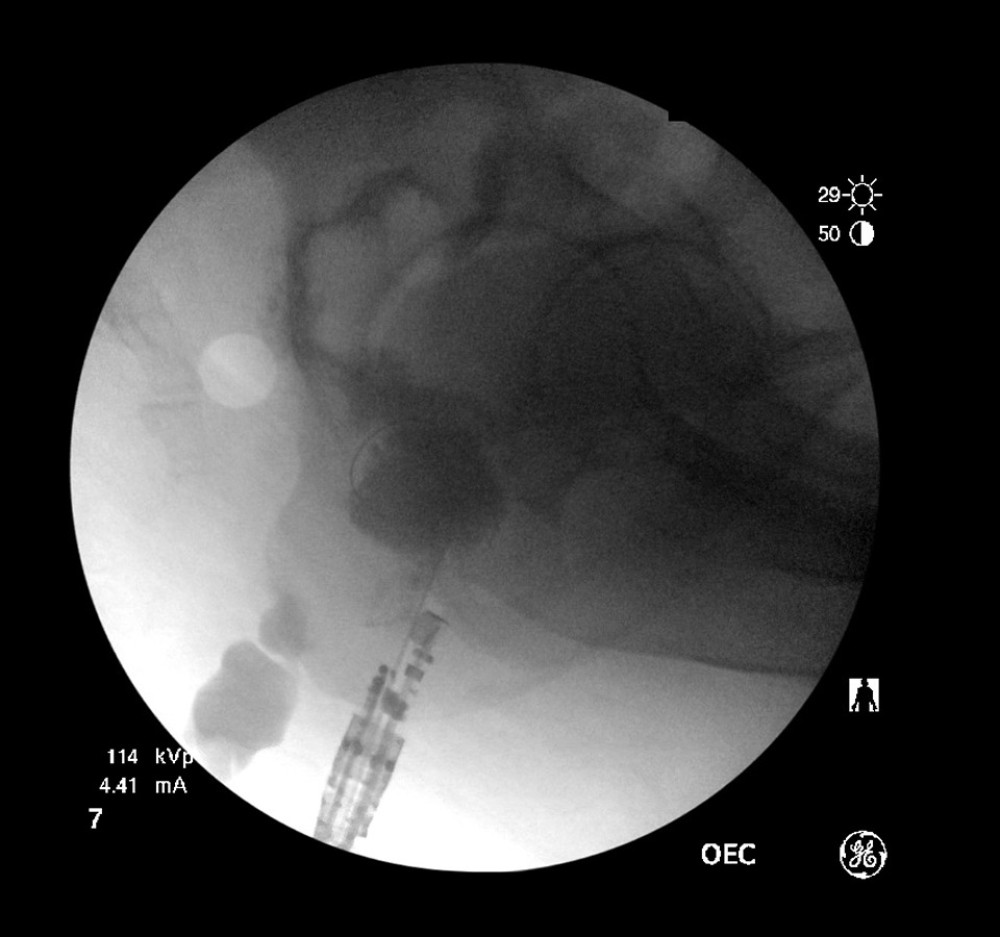 A 10F, 5-cm, double pigtail biliary-type plastic stent is successfully deployed. Upon contrast injection, the abscess cavity is seen to communicate with another fluid collection.