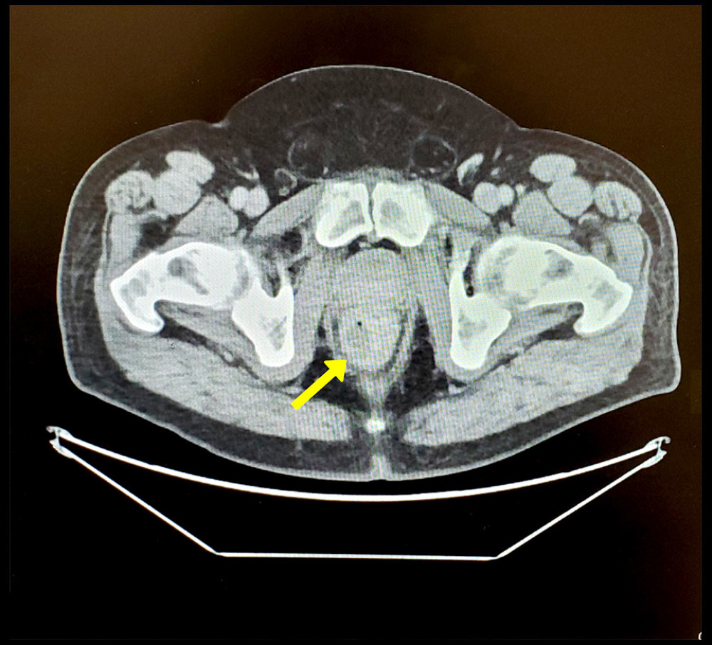 A postoperative computed tomography scan of the abdomen and pelvis shows that the abscess cavity is smaller.