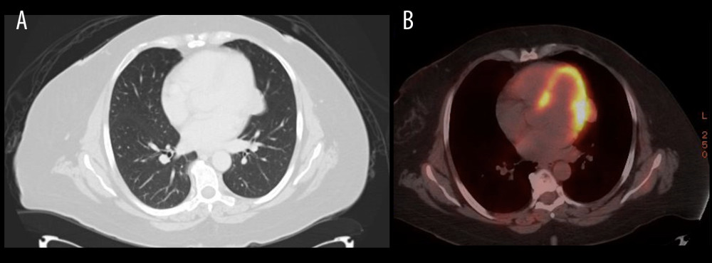 (A) CT scan of the lung showing suspicious nodule at the lingula abutting the heart border. (B) PET scan showing lung nodule at the lingula in a paracardiac position, measuring 1.5×3.4 cm and showing increased fluorodeoxyglucose accumulation (maximum standardized uptake value, 1.5).