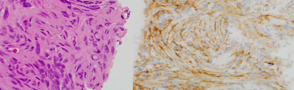 Lung biopsy showing meningioma with intranuclear inclusion; immunostaining for epithelial membrane antigen was positive.