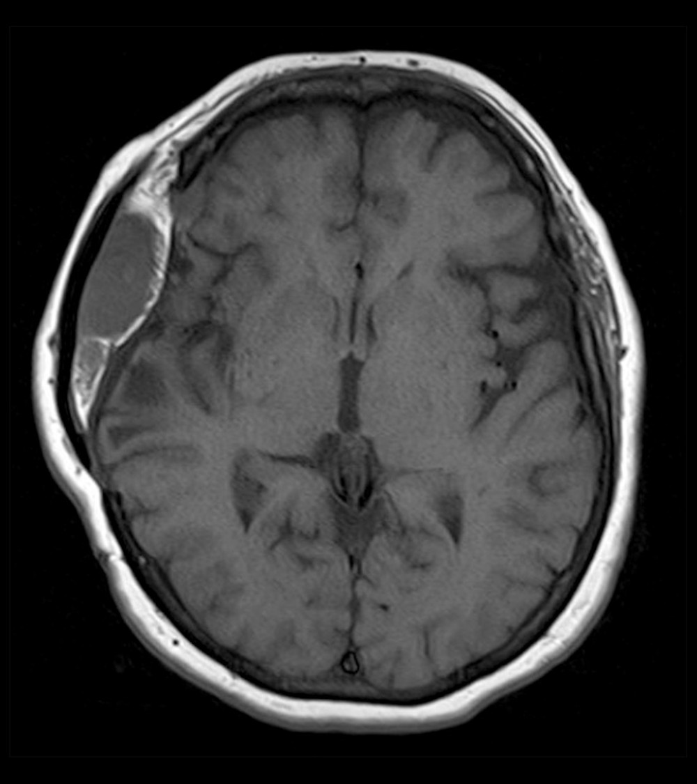 MRI of the brain, axial plane, revealing new brain lesion.