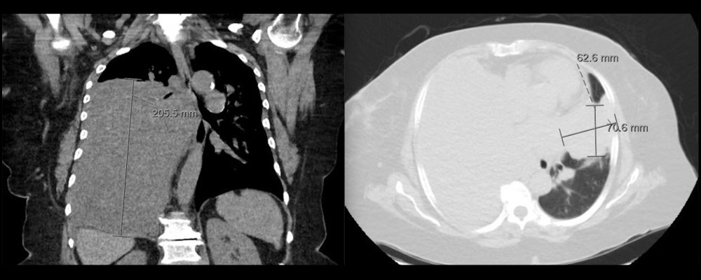 Chest CT, coronal and axial plane, showing progression of lung nodules.