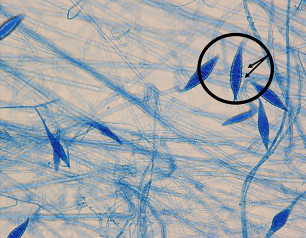 Light microscopy findings. Lactophenol-Cotton Blue staining of the species grown from the patient’s skin. Characteristic ship-like and spindle-shaped macroconidia with granular spikes on the surface are found (arrows and circles, ×1000).