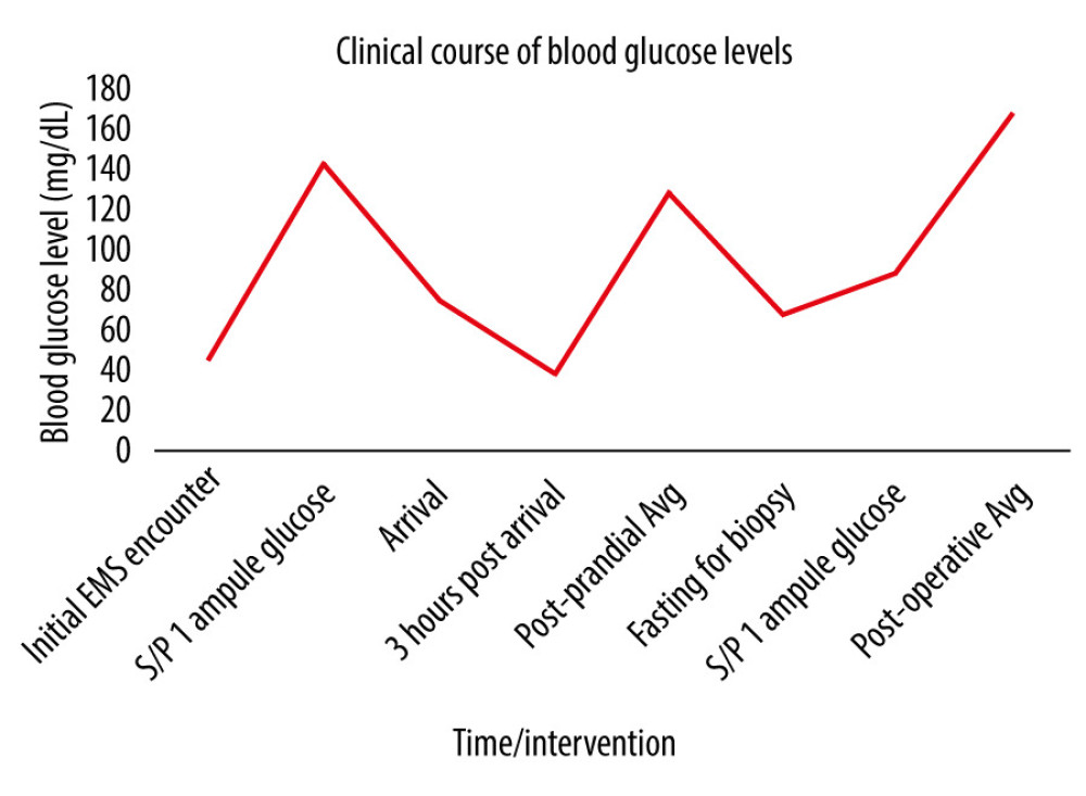 A timeline of blood glucose levels through the patient’s clinical course from initial Emergency Medical Services (EMS) encounter to discharge. The patient was able to maintain a normal average blood glucose level of 128 mg/dL with regular feedings and continued to experience dramatic, recurrent hypoglycemic events with cessation of feedings (3 h post-prandial and fasting for biopsy) that corrected with supplemental glucose administration (status-post (S/P) 1 ampule glucose). Note the significant stabilization of blood glucose levels to an average of 167 mg/dL following resection of the tumor.